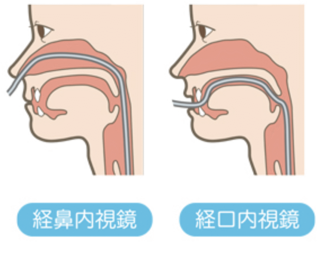 経鼻(または経口)での検査